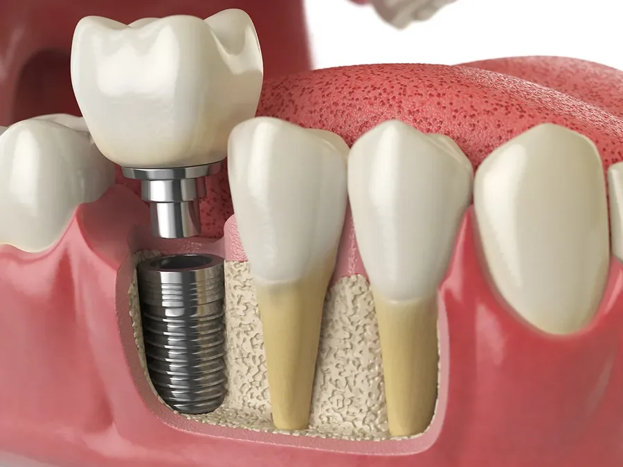 Illustration of a dental implant fixture and crown placed beside natural teeth