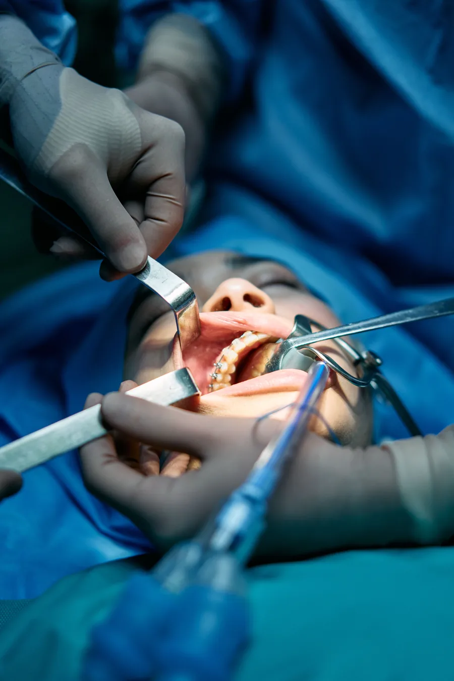 Surgical instruments positioned during a minor oral surgery procedure