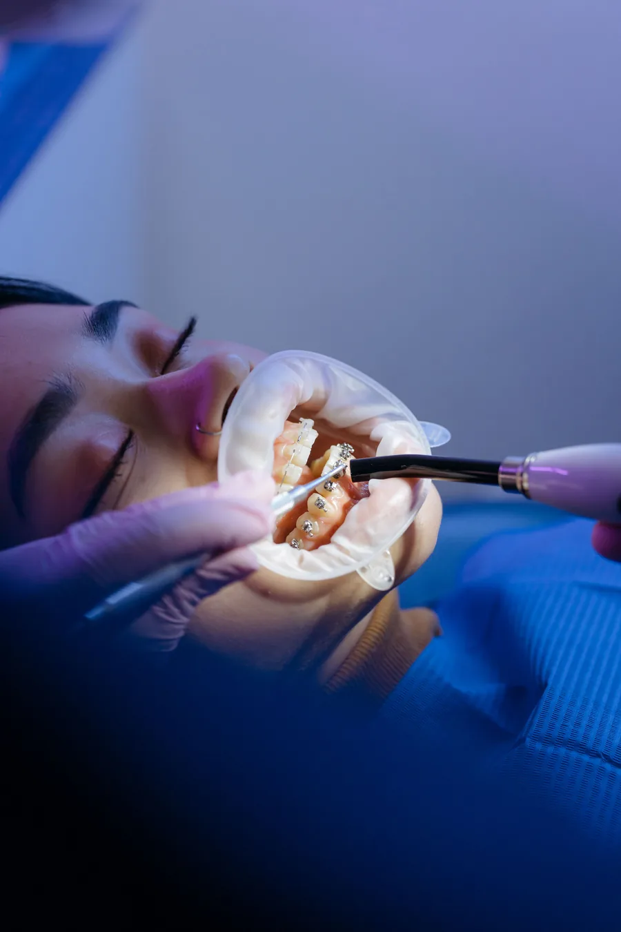 Patient with braces having their teeth adjusted during an orthodontic visit